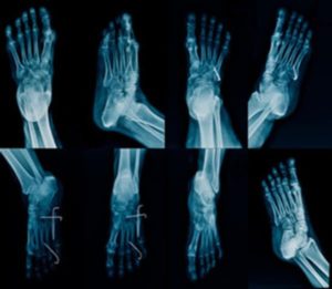 Xray of bunions before and after surgery