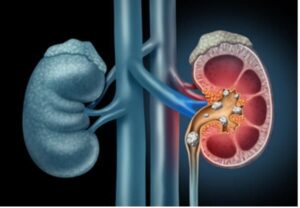 Healthy kidney versus unhealthy kidney.